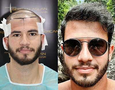 Методика пересадки волос DHI в Турции (4500 трансплантатов)