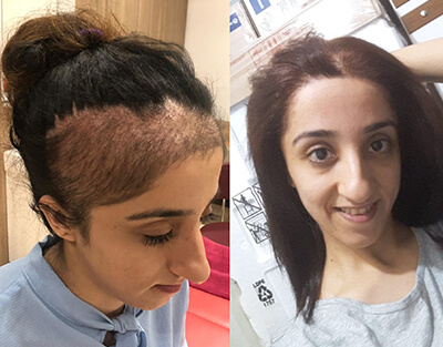 Клиника трансплантации волос DHI в Стамбуле (5000 трансплантатов)