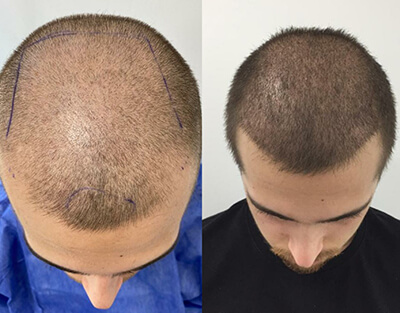 Клиника по пересадке волос DHI в Турции (5000 трансплантатов)