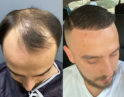Процедура трансплантации волос FUE Sapphire в Турции (5000 трансплантатов)