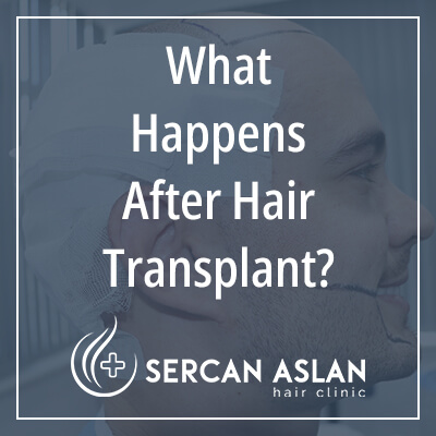 что происходит после пересадки волос?
